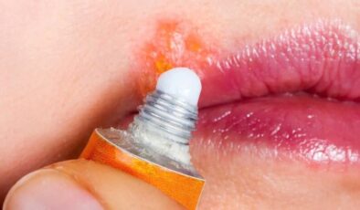 Dudağınızın dostu, uçukların düşmanı! İşte en düzgün 5 uçuk kremi